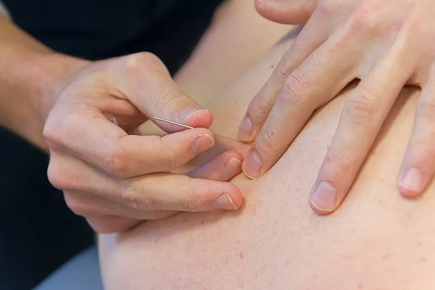 Dry Needling treatment